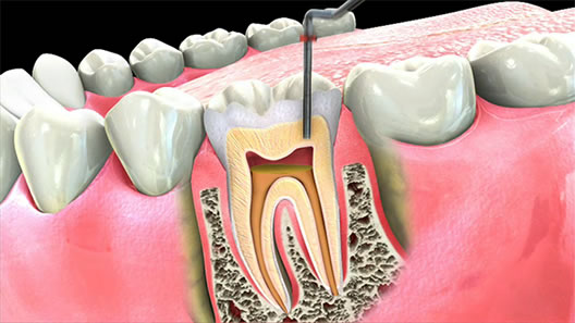 root canal picture