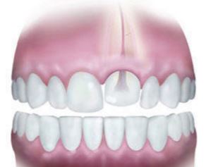 What is tooth canal treatment What is tooth canal treatment
